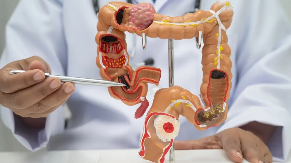 Médico fazendo demonstração em uma reprodução de um intestino